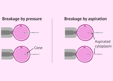 ICSI Breakage Types